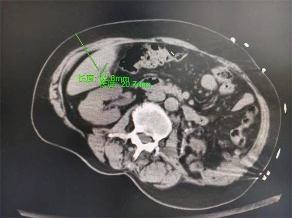 【杨柳科普】局部根治：带你认识肝脏肿瘤的消融治疗