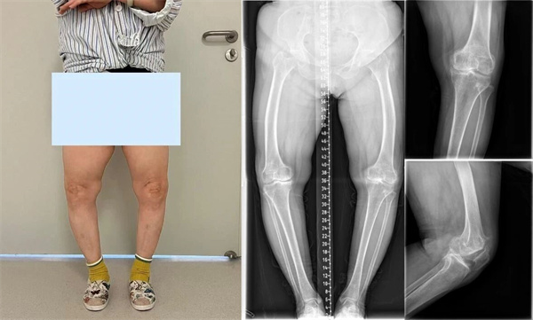【杨柳探营】运动医学与关节外科(骨二科)成功实施高难度LCCK膝关节置换术